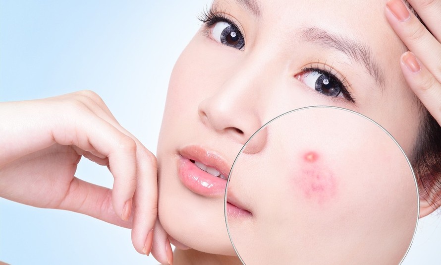 điều trị mụn ở Cần Thơ