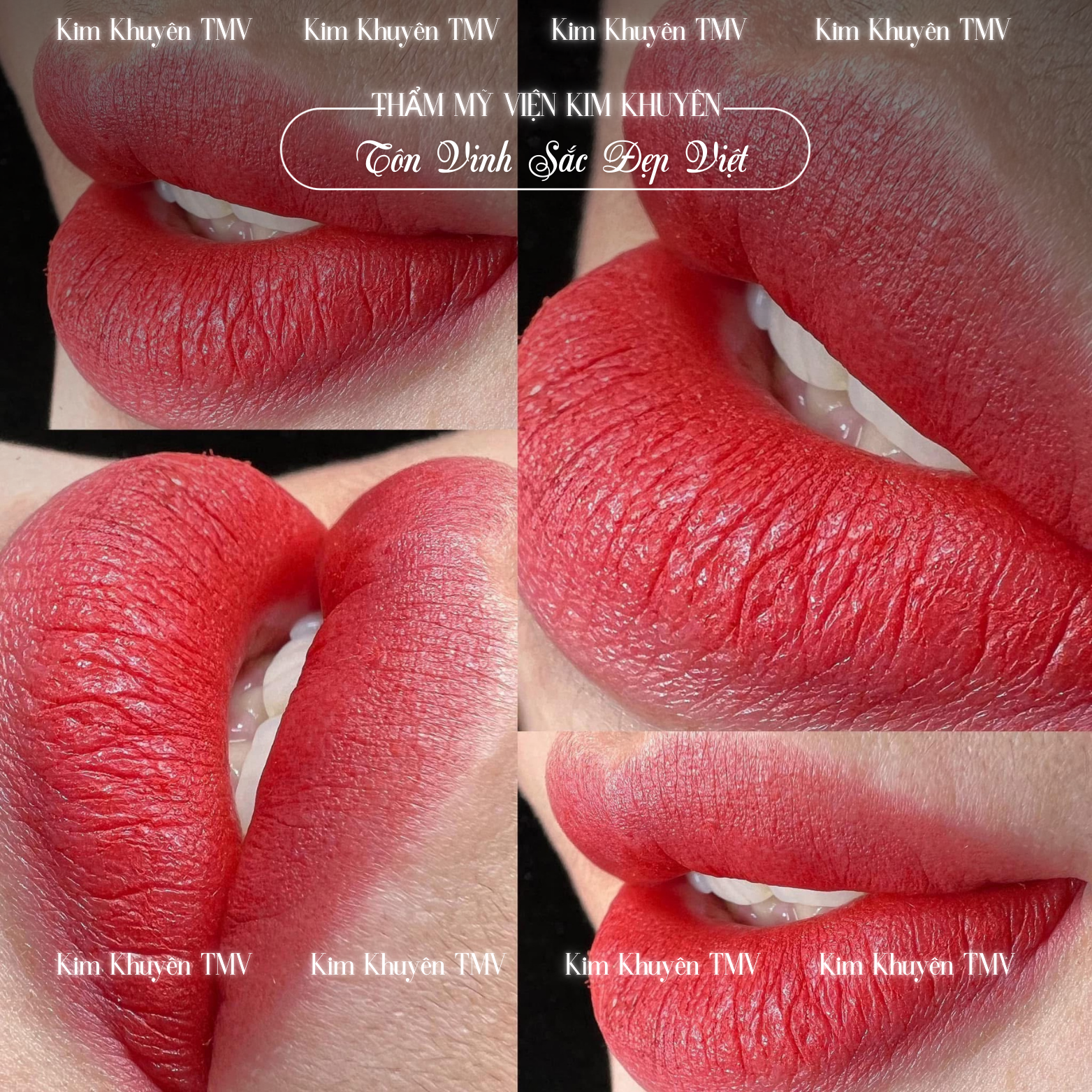 Phun Môi Xong Có Bị Thâm Không? Giải Đáp Chi Tiết Từ Chuyên Gia